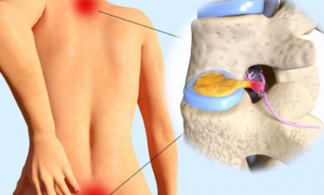 四招動作 助你改善椎間盤突出