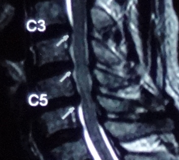頸椎椎間盤最常見受壓的頸椎關節是頸椎第5節和第6節（C5,6）