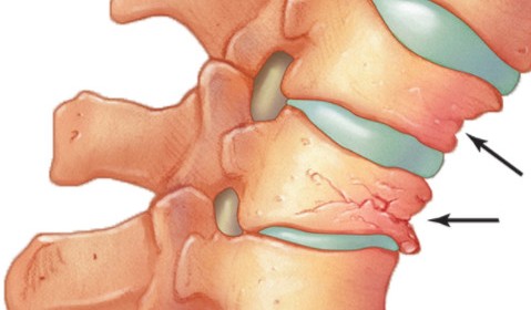 認識脊椎骨質疏鬆性骨折