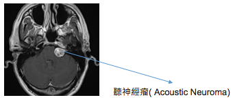 acoustic-neuroma-1