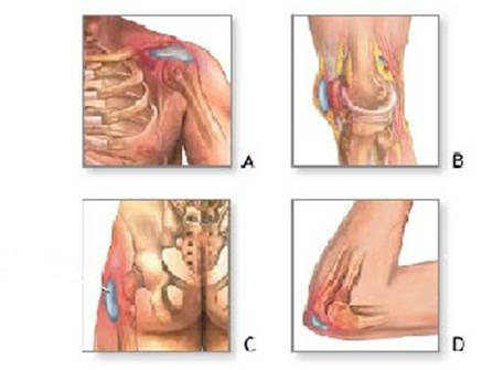 黏液囊   A.     肩膊        B. 膝關節       C.    股骨        D.    手肘