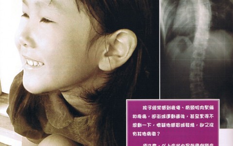 兒童脊骨側彎症