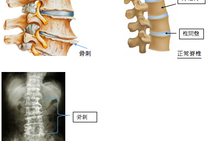 矯正錯誤姿勢避免骨質增生