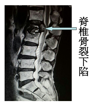 osteoporosis02
