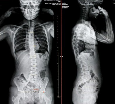 脊骨側彎檢查Ｘ光，從Ｘ光片中找出脊骨側彎的弧度