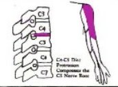 圖一︰C4－C5椎節壓著C5神經線