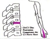 圖三︰C6－C7椎節壓著C7神經線