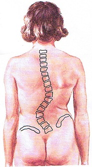 （圖三）左腰椎側 彎弧度70°及盤骨高低
