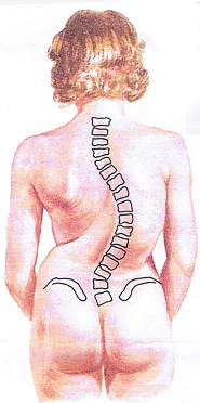 （圖二）右胸腰椎側彎弧度70°