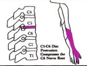 圖二︰C5－C6椎節壓著C6神經線
