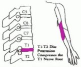 圖五︰T1－T2椎節壓著T1神經線
