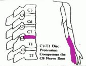 圖四︰C7－T1椎節壓著C8神經線